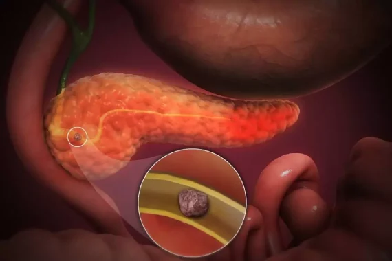 Pancreatitis: Comprehensive Guide and Treatment at Globus Gastroenterology Hospital